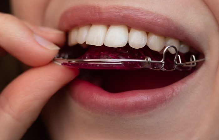 The Benefits of Braces from Liverpool's Leading Orthodontists