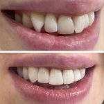 Composite Bonding: Tailoring Unique Smiles with Artistic Precision