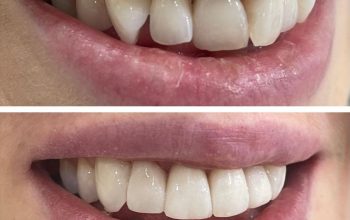 Composite Bonding: Tailoring Unique Smiles with Artistic Precision