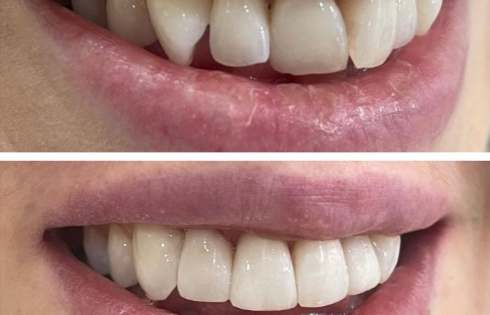 Composite Bonding: Tailoring Unique Smiles with Artistic Precision