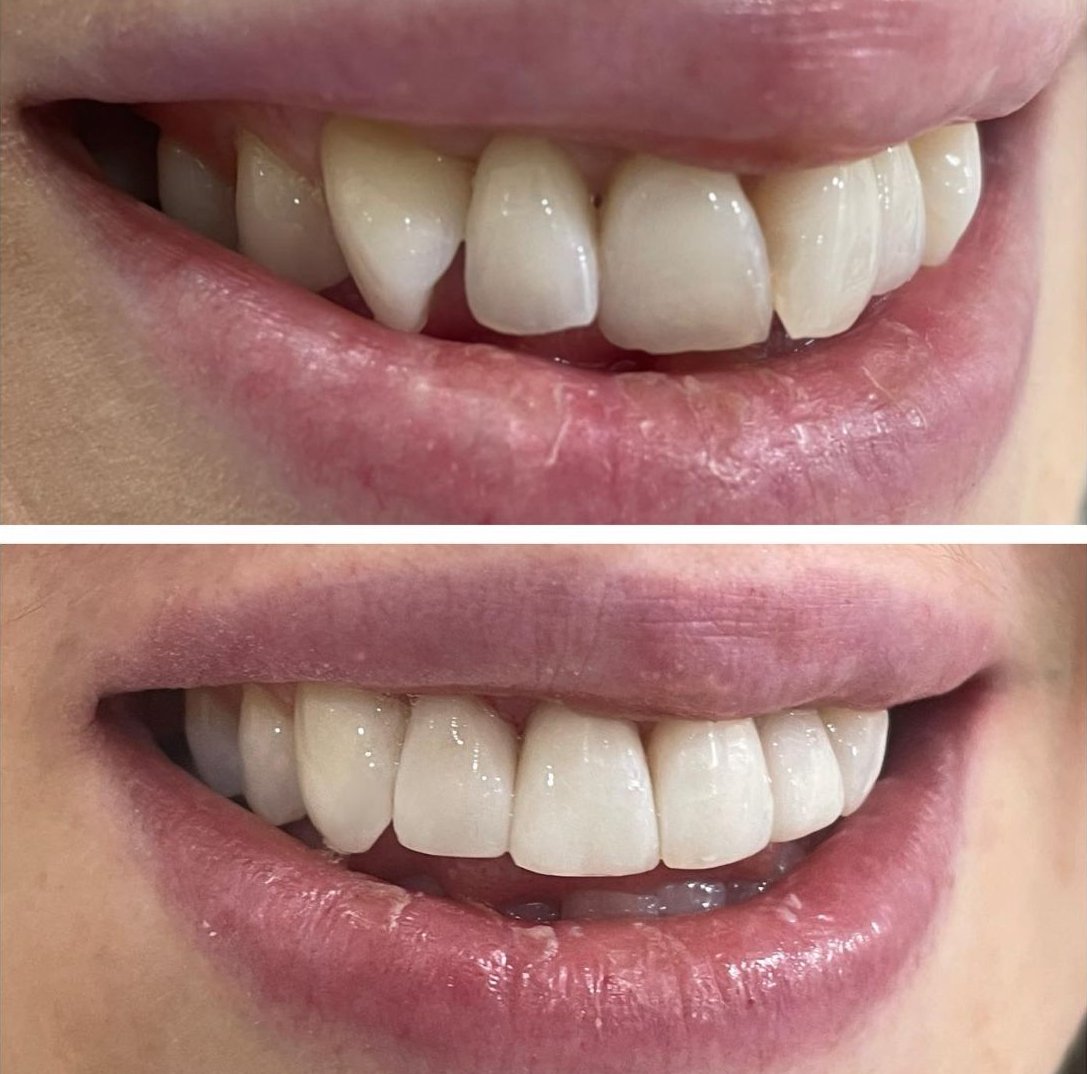 Composite Bonding: Tailoring Unique Smiles with Artistic Precision